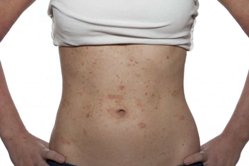 Аллергия на коже: виды, проявления, симптомы и варианты лечения. 140 фото и видео советы по выявлению аллергена