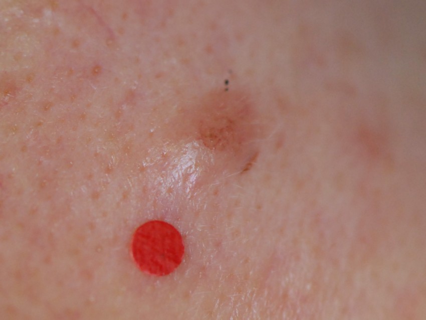 Белая родинка: причины, симптомы, опасность и диагностика серьезных заболеваний. 125 фото злокачественных и доброкачественных родинок