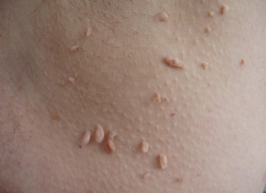 Белая родинка: причины, симптомы, опасность и диагностика серьезных заболеваний. 125 фото злокачественных и доброкачественных родинок