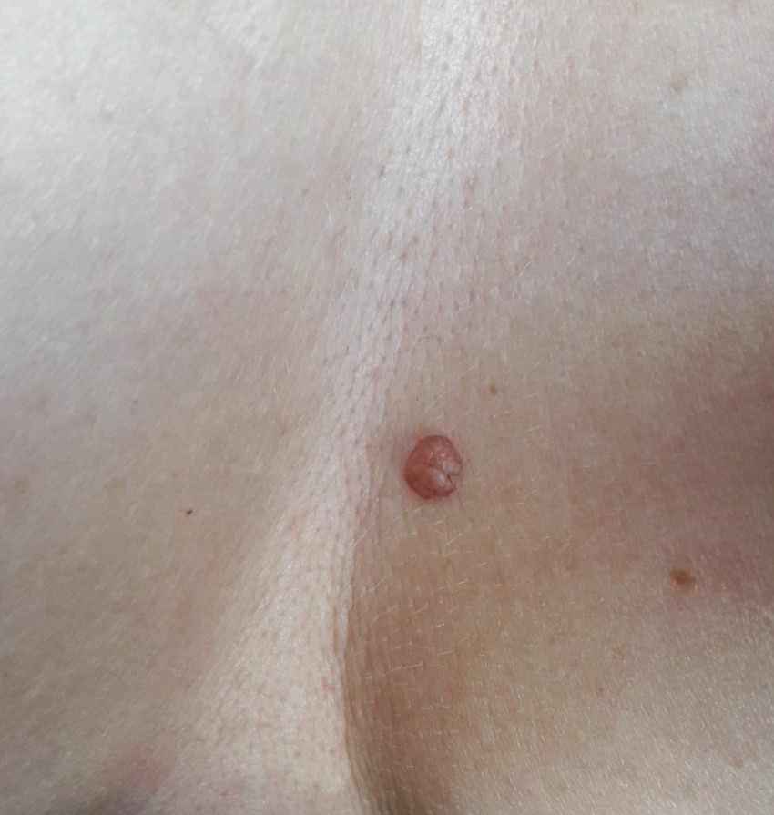 Белая родинка: причины, симптомы, опасность и диагностика серьезных заболеваний. 125 фото злокачественных и доброкачественных родинок