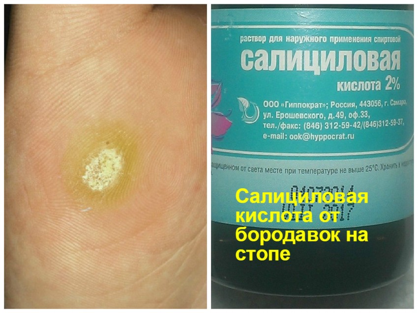 Вывести бородавки в домашних условиях - удаление бородавки своими руками. Пошаговая инструкция и отзывы о самых эффективных методах (130 фото + видео)