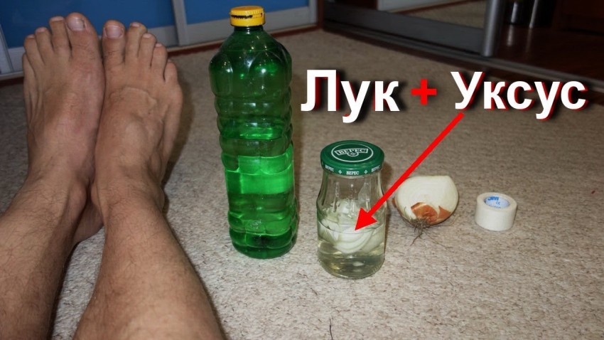 Вывести бородавки в домашних условиях - удаление бородавки своими руками. Пошаговая инструкция и отзывы о самых эффективных методах (130 фото + видео)