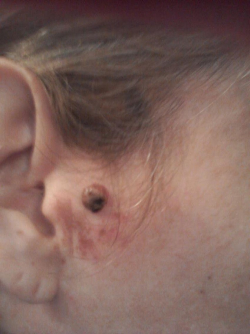 Бородавки на лице: можно ли удалять своими руками? Советы косметологов, 105 фото и видео инструкция по удалению бородавок