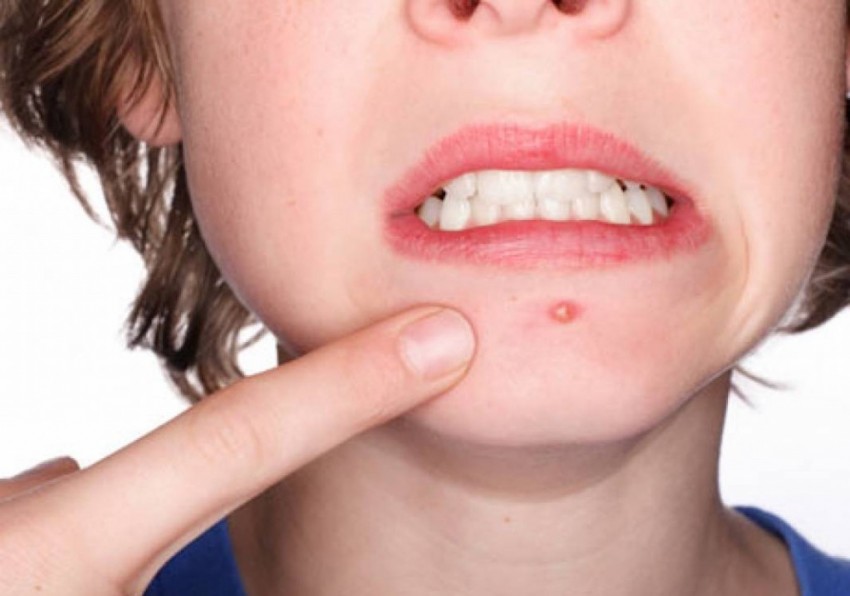 Бородавки на лице: можно ли удалять своими руками? Советы косметологов, 105 фото и видео инструкция по удалению бородавок