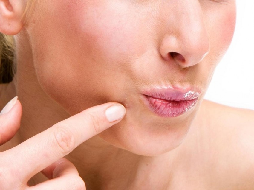 Бородавки на лице: можно ли удалять своими руками? Советы косметологов, 105 фото и видео инструкция по удалению бородавок