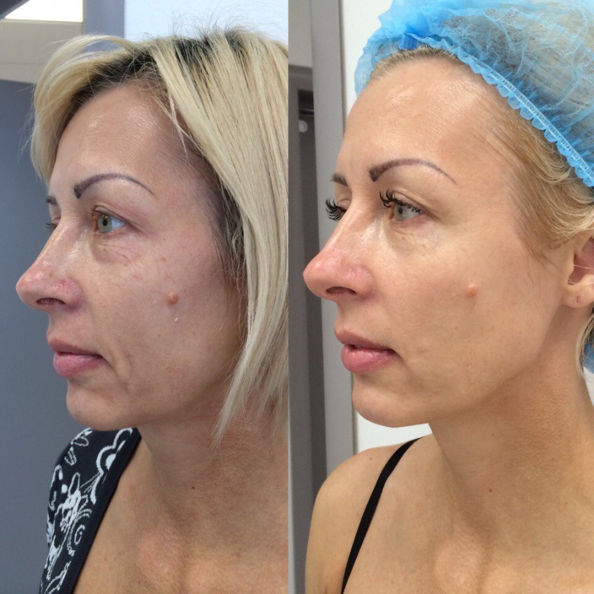 Бородавки на лице: можно ли удалять своими руками? Советы косметологов, 105 фото и видео инструкция по удалению бородавок