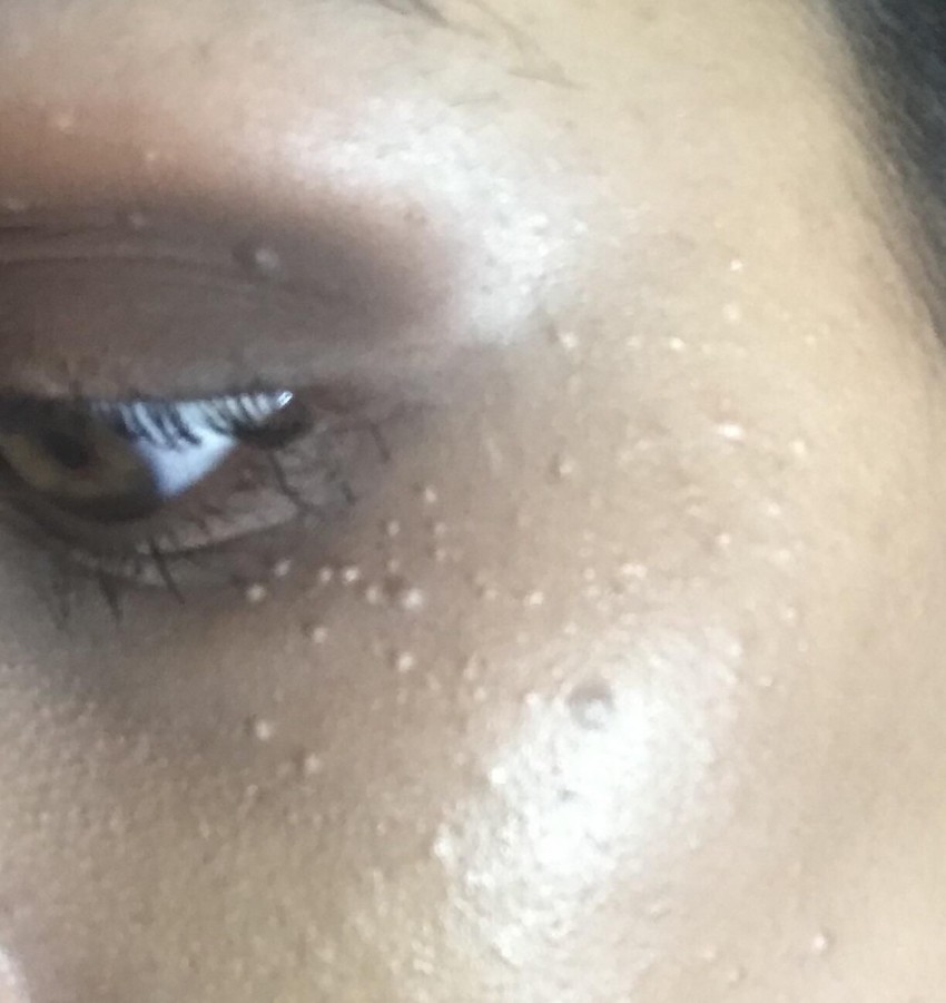 Бородавки на лице: можно ли удалять своими руками? Советы косметологов, 105 фото и видео инструкция по удалению бородавок