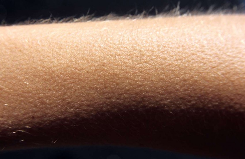 Гусиная кожа: причины появления, методы избавления и основные симптомы заболевания (120 фото и видео)