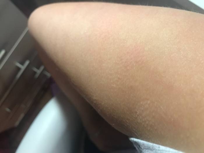 Гусиная кожа: причины появления, методы избавления и основные симптомы заболевания (120 фото и видео)