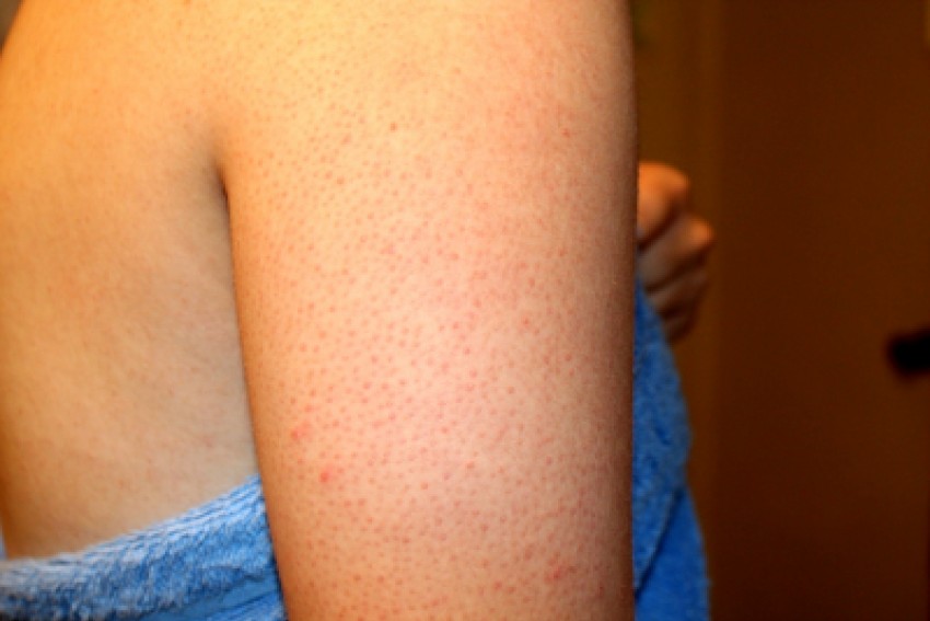 Гусиная кожа: причины появления, методы избавления и основные симптомы заболевания (120 фото и видео)