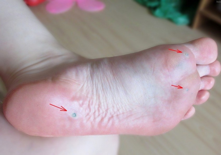 Как вывести бородавку: к какому врачу идти, современные методы удаления и профилактика лечения бородавок (85 фото)