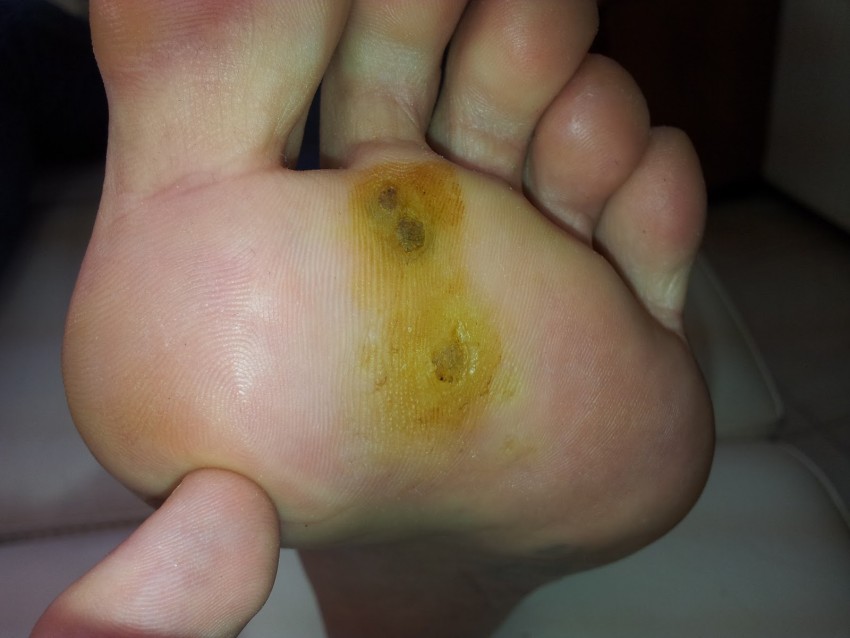 Как вывести бородавку: к какому врачу идти, современные методы удаления и профилактика лечения бородавок (85 фото)