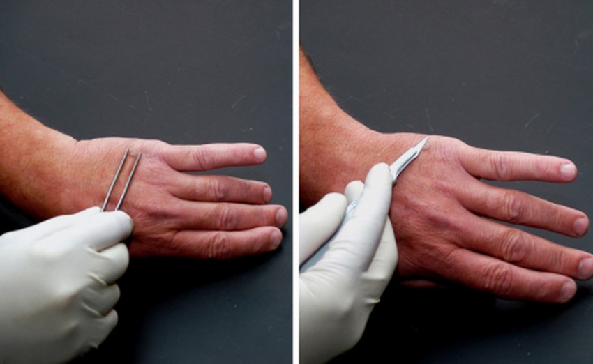 Как вывести бородавку: к какому врачу идти, современные методы удаления и профилактика лечения бородавок (85 фото)