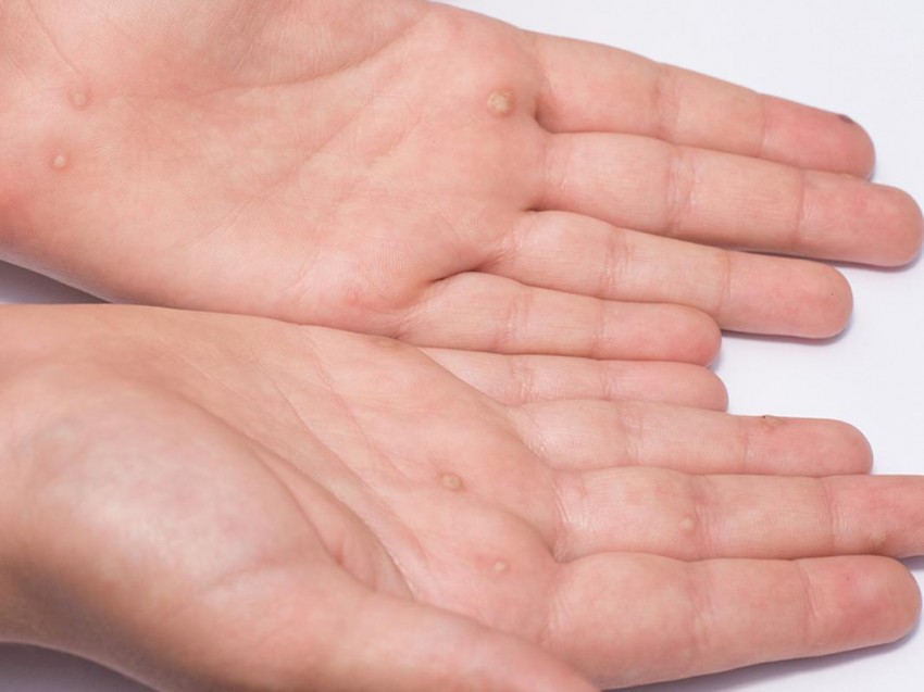 Как вывести бородавку: к какому врачу идти, современные методы удаления и профилактика лечения бородавок (85 фото)