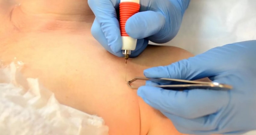 Лечение бородавок - симптомы, причины и диагностика заболевания. Советы по выбору специалиста и методики лечения (95 фото)