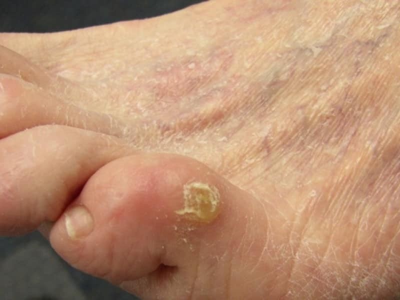 Лечение бородавок - симптомы, причины и диагностика заболевания. Советы по выбору специалиста и методики лечения (95 фото)