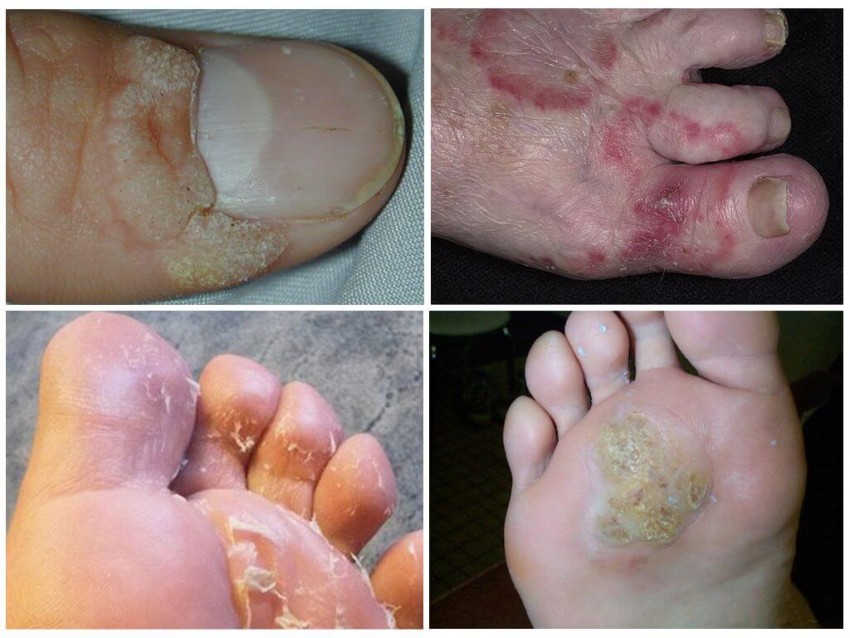 Лечение грибка - советы опытных врачей по подбору эффективных средств избавления от грибка (90 фото)