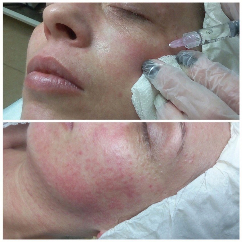 Мезотерапия лица: зоны применения, эффективность и советы по выбору специалиста. 145 фото и видео процедуры