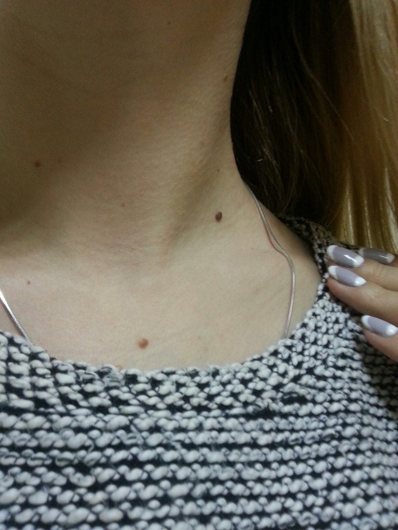 Много родинок - к какому врачу обращаться, опасные формы и определение типов родинок (90 фото)