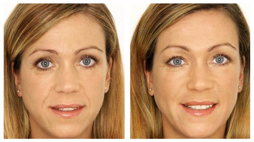Плазмолифтинг - пошаговое описание, советы по применению и стоимость процедуры (125 фото и видео)
