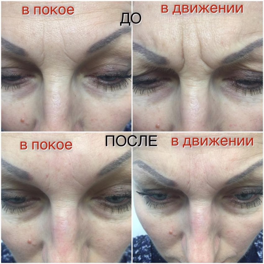 Плазмолифтинг - пошаговое описание, советы по применению и стоимость процедуры (125 фото и видео)