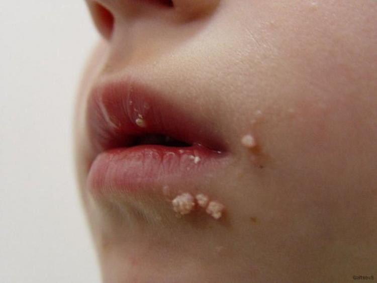 Плоские бородавки - диагностика причин появления, симптомы, проявления и особенности лечения (110 фото и видео)