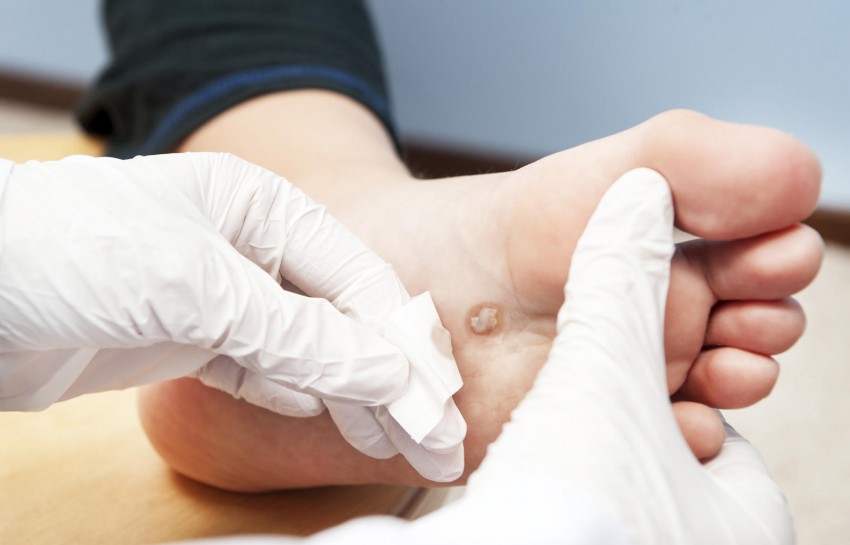 Плоские бородавки - диагностика причин появления, симптомы, проявления и особенности лечения (110 фото и видео)