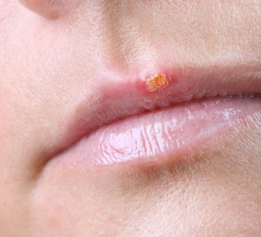 Прыщ на губе: причины появления, виды и особенности лечения. Советы медиков и 110 фото прыщей на губах