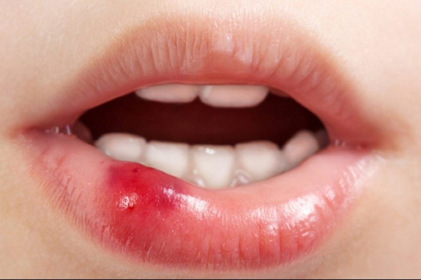 Прыщ на губе: причины появления, виды и особенности лечения. Советы медиков и 110 фото прыщей на губах