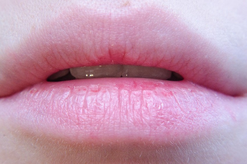 Прыщ на губе: причины появления, виды и особенности лечения. Советы медиков и 110 фото прыщей на губах