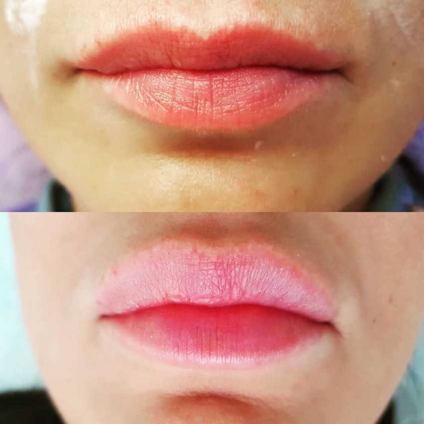 Прыщ на губе: причины появления, виды и особенности лечения. Советы медиков и 110 фото прыщей на губах