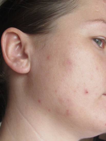 Прыщ в ухе: причины появления и лечение фурункулов. Профилактика заболевания и методы удаления у взрослых и детей (75 фото)