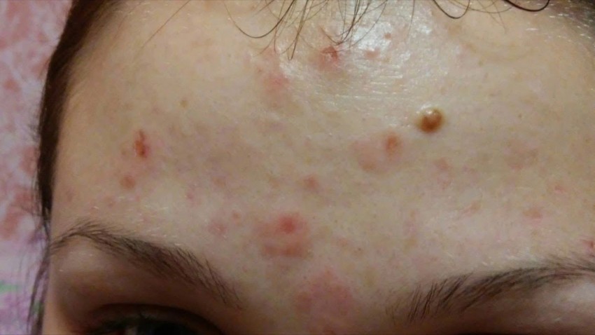 Прыщи на лбу: причины появления, основные виды, медикаментозное и косметологическое лечение (125 фото и видео)