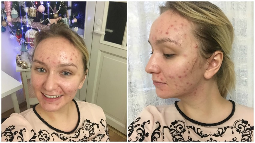 Прыщи на лбу: причины появления, основные виды, медикаментозное и косметологическое лечение (125 фото и видео)