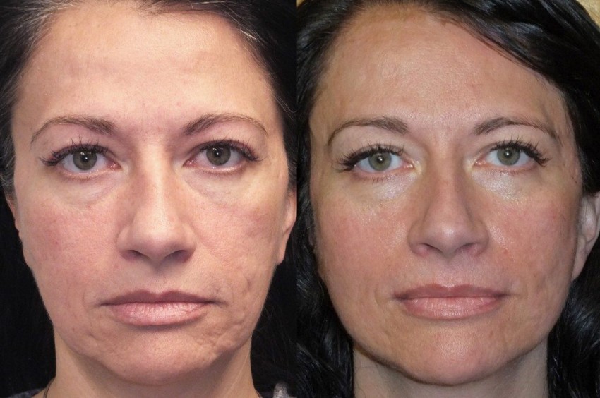 Прыщи на лбу: причины появления, основные виды, медикаментозное и косметологическое лечение (125 фото и видео)