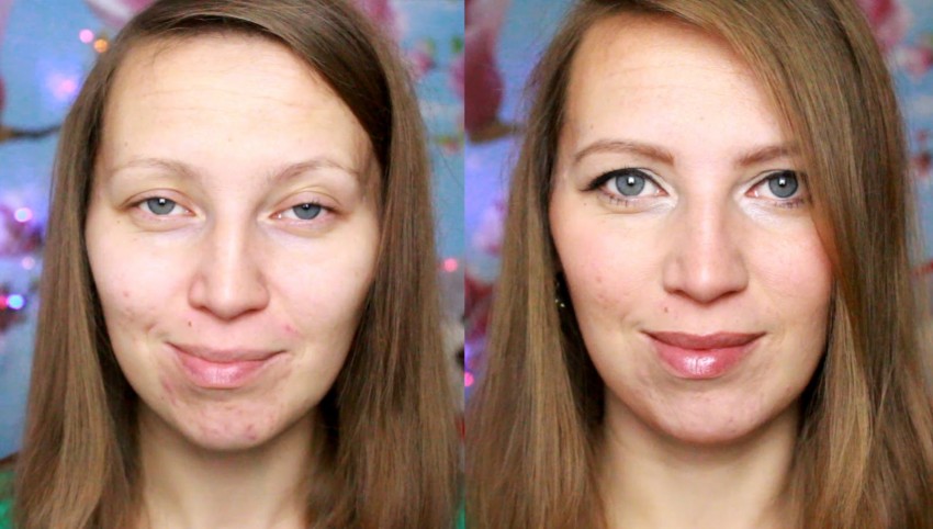 Прыщи на лбу: причины появления, основные виды, медикаментозное и косметологическое лечение (125 фото и видео)