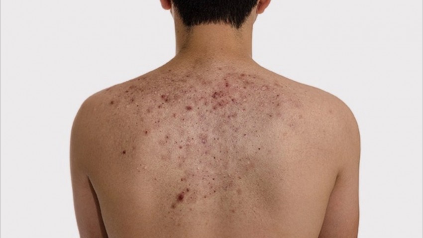 Прыщи на спине: причины появления и способы избавления. 120 фото лучших средств и видео описание видов прыщей