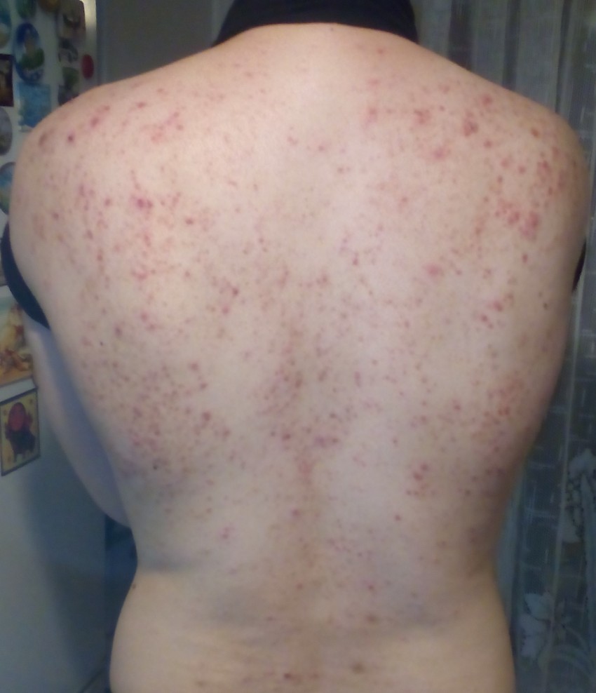 Прыщи на спине: причины появления и способы избавления. 120 фото лучших средств и видео описание видов прыщей