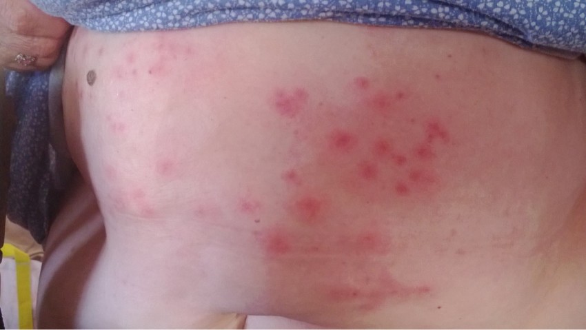 Прыщи на спине: причины появления и способы избавления. 120 фото лучших средств и видео описание видов прыщей