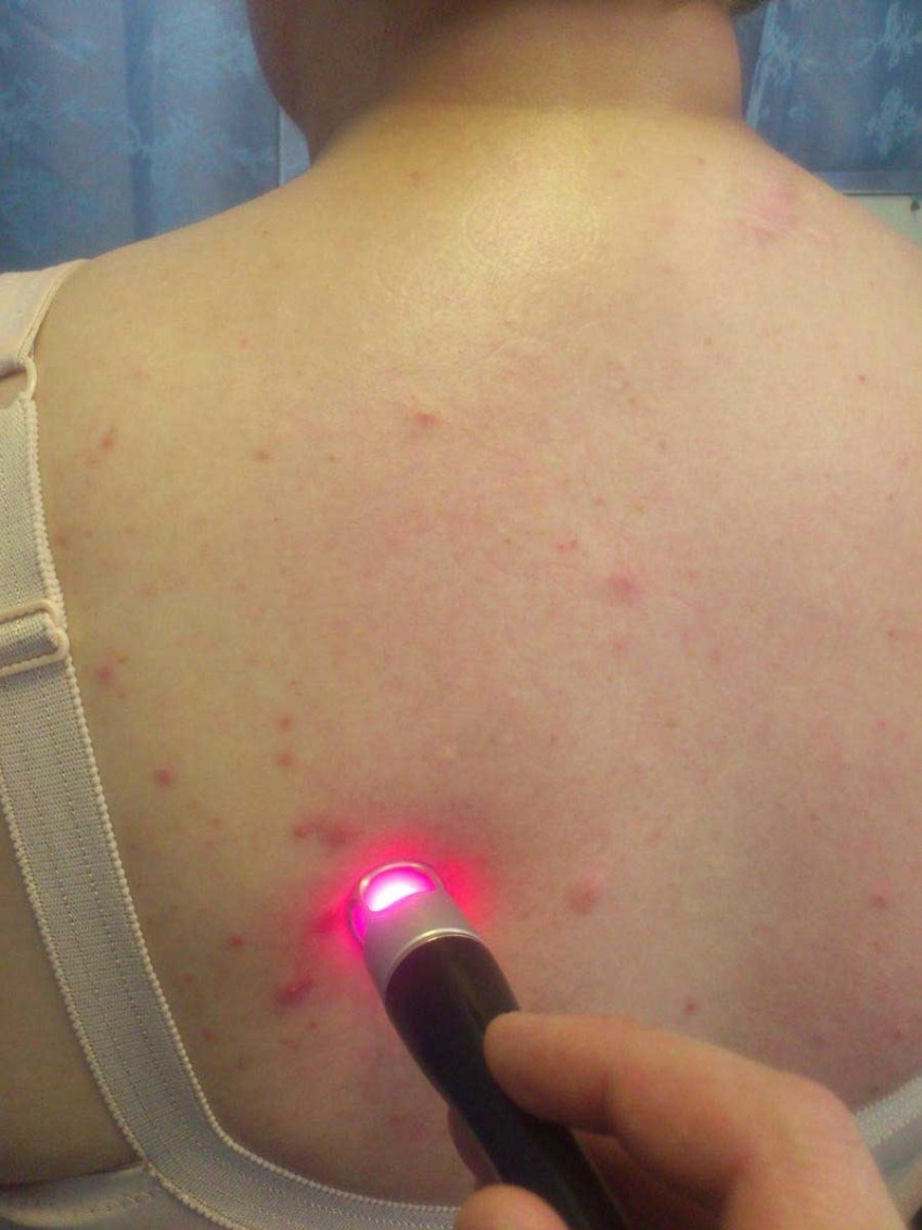 Прыщи на спине: причины появления и способы избавления. 120 фото лучших средств и видео описание видов прыщей