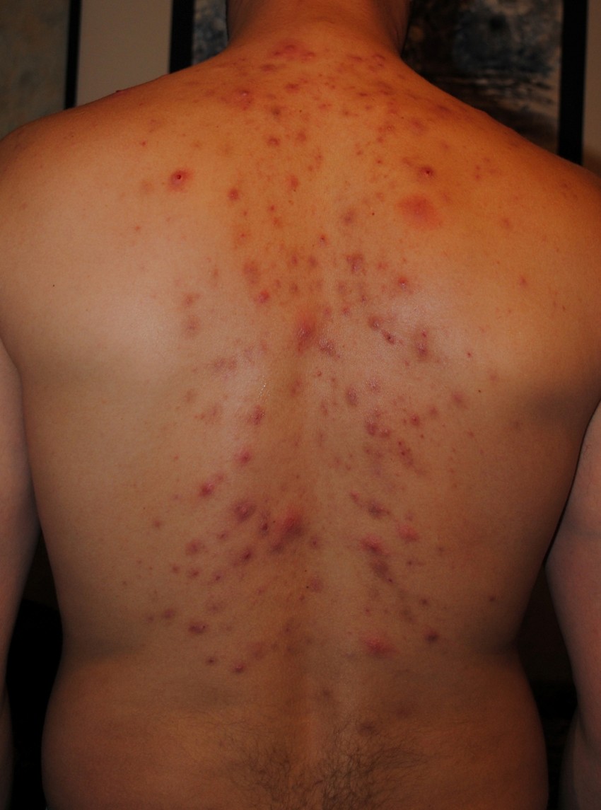 Прыщи на спине: причины появления и способы избавления. 120 фото лучших средств и видео описание видов прыщей
