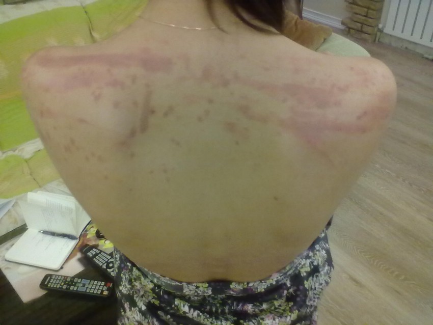 Прыщи на спине: причины появления и способы избавления. 120 фото лучших средств и видео описание видов прыщей