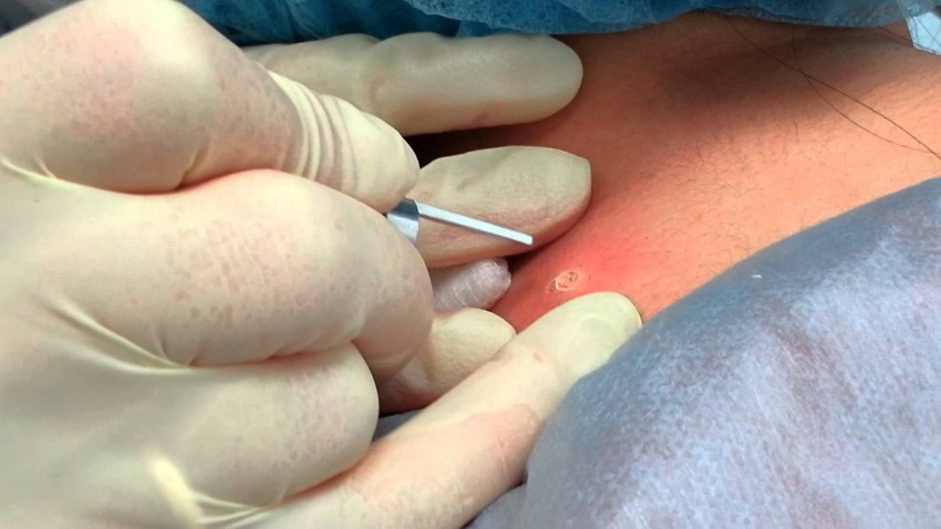 Прыщи на спине: причины появления и способы избавления. 120 фото лучших средств и видео описание видов прыщей