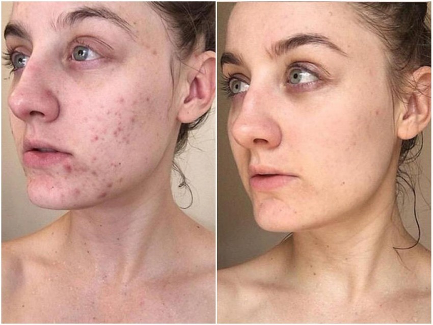 Прыщи на висках - особенности и причины появления. Принципы и методы современного лечения и избавления от прыщей (90 фото + видео)