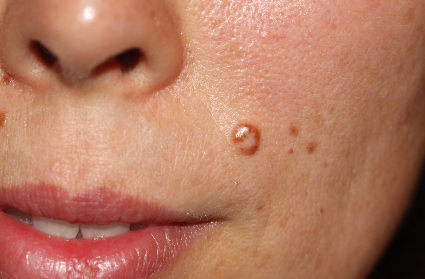Родинка на губе: причины появления, как убрать и к какому специалисту обращаться лучше всего (видео + 125 фото)