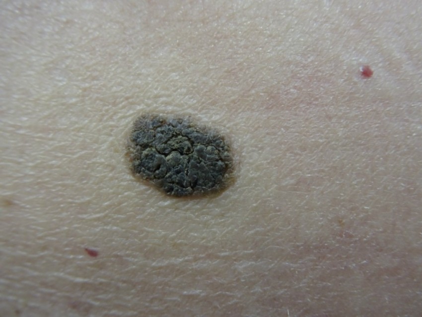 Родинка на ноге: описание, причины появления и советы к удалению. 95 фото безопасных и опасных родинок