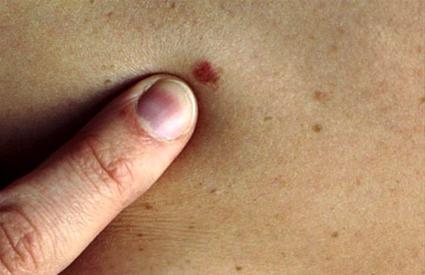 Родинка на ноге: описание, причины появления и советы к удалению. 95 фото безопасных и опасных родинок