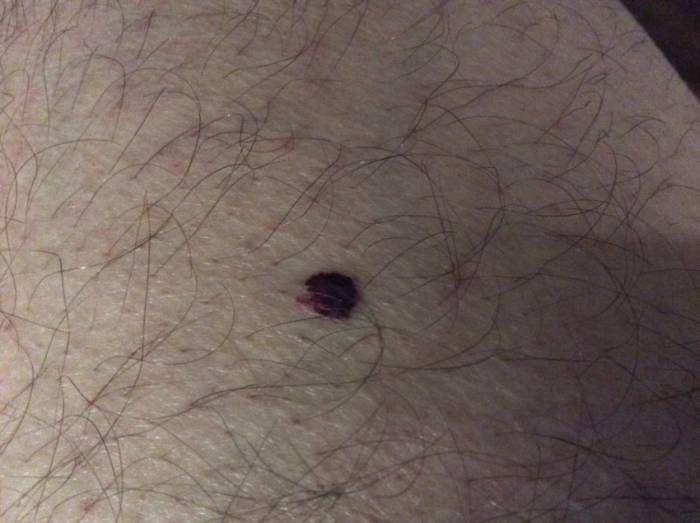 Родинка на ноге: описание, причины появления и советы к удалению. 95 фото безопасных и опасных родинок