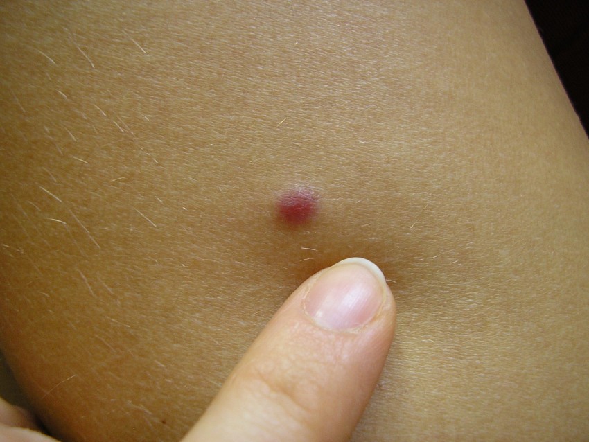 Виды родинок: доброкачественные, злокачественные родинки их особенности и определение. 115 фото и видео разных типов родинок