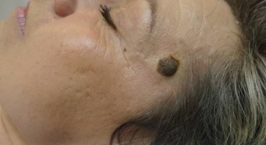 Виды родинок: доброкачественные, злокачественные родинки их особенности и определение. 115 фото и видео разных типов родинок